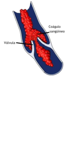 trombose_venosa_profunda